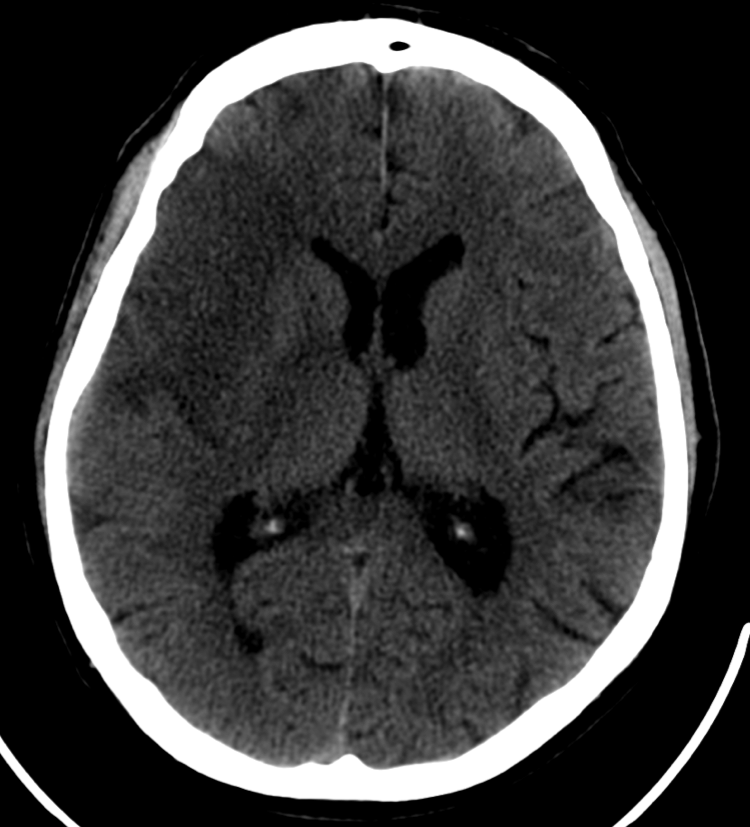 Un cerebro con ictus isquémico visto a través de una tomografía computarizada en el Hospital Clínico Universitario de Valladolid. Autor: Hospital Clínico Universitario de Valladolid